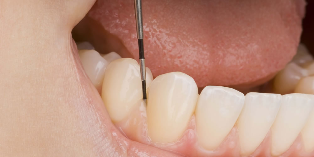 歯茎が下がる歯肉退縮の原因について