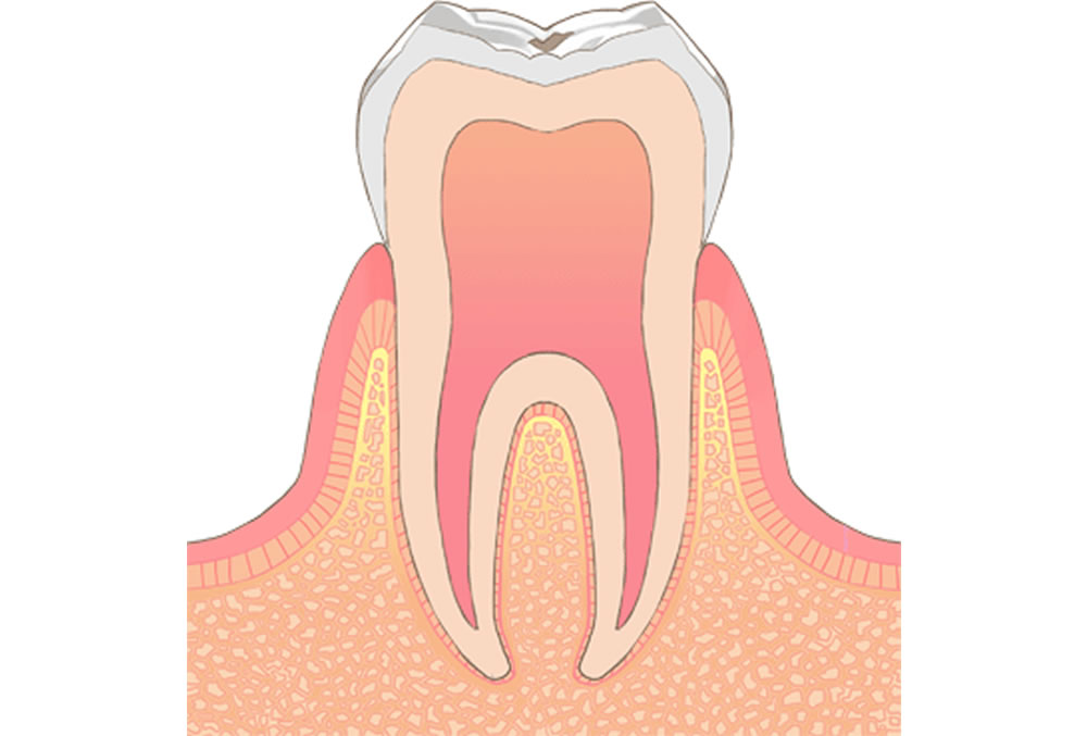 C0(脱灰)・C1(エナメル質の虫歯)