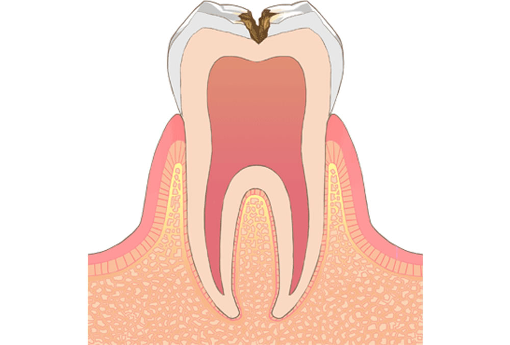 C2(象牙質の虫歯)