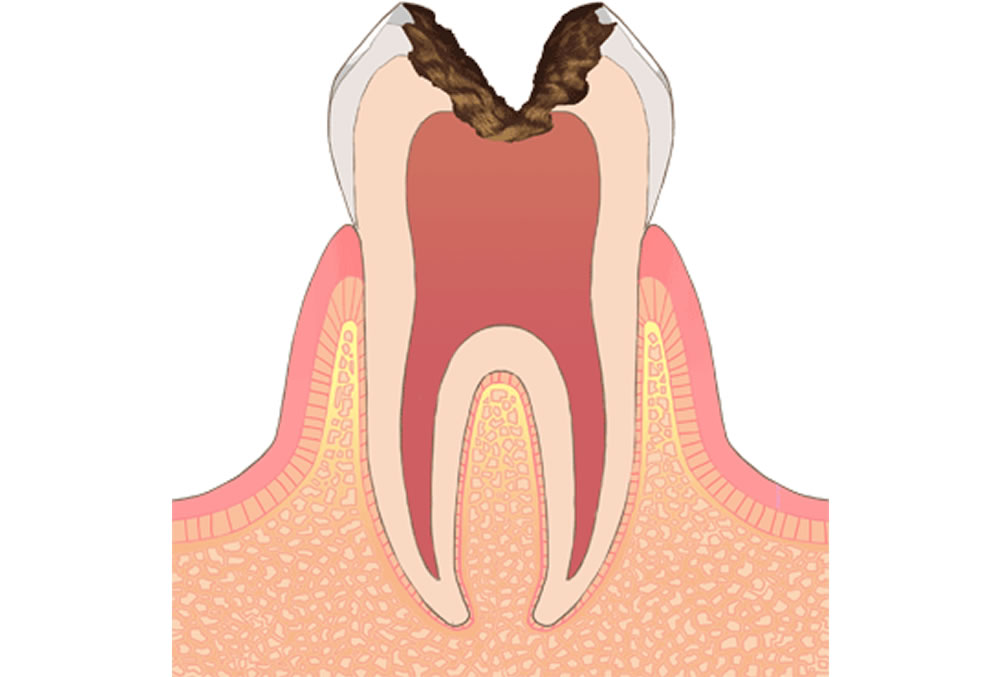 C3(歯の神経の虫歯)