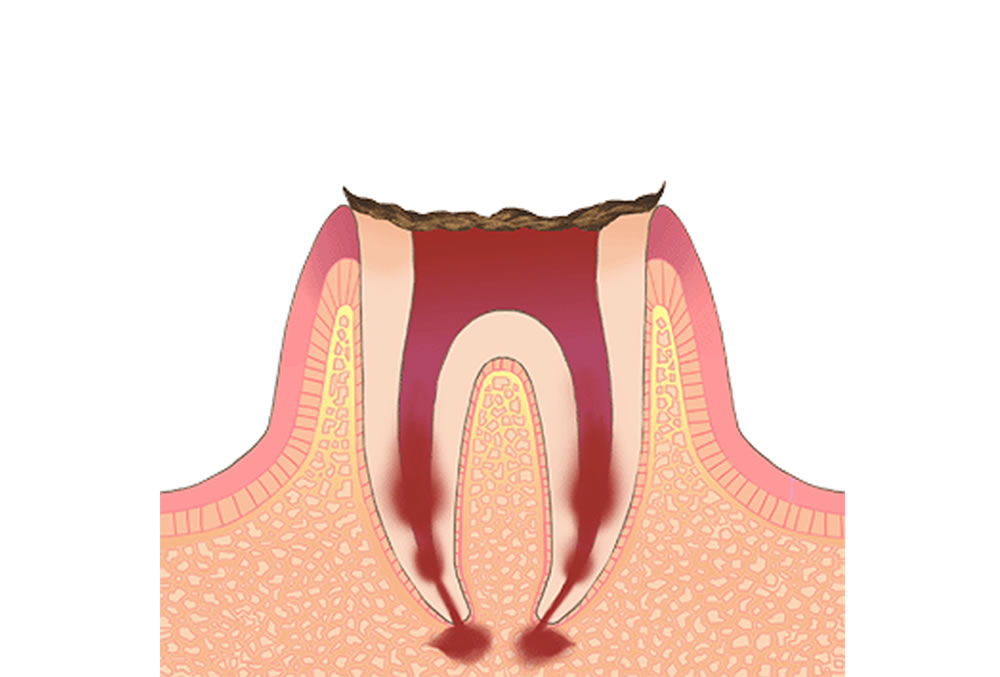 C4(歯根の虫歯)