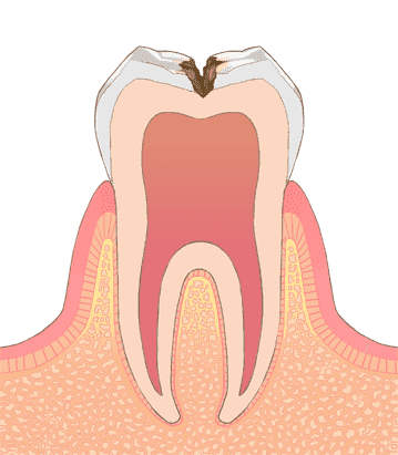 虫歯にならないためのきれいな歯並び作り
