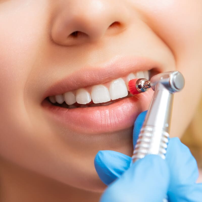 PMTC（Professional Mechanical Tooth Cleaning）