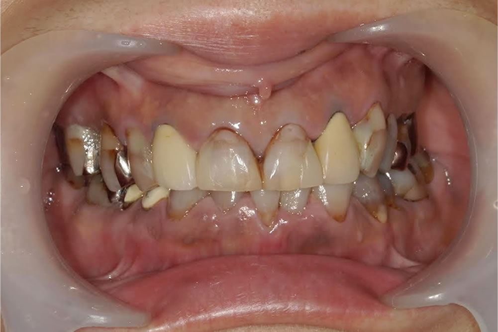  セラミック治療で前歯の見た目を改善した症例