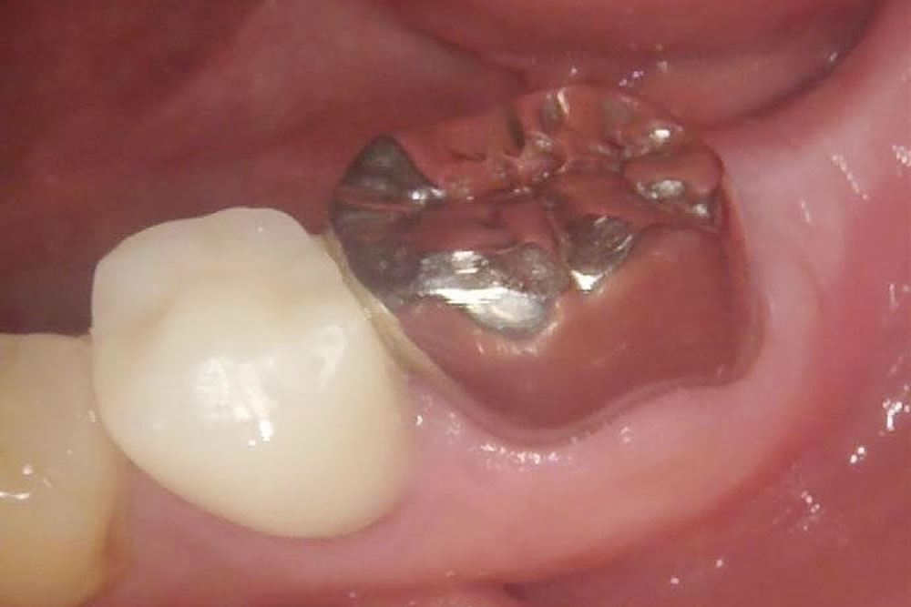 セラミック治療で銀歯の見た目を改善した症例