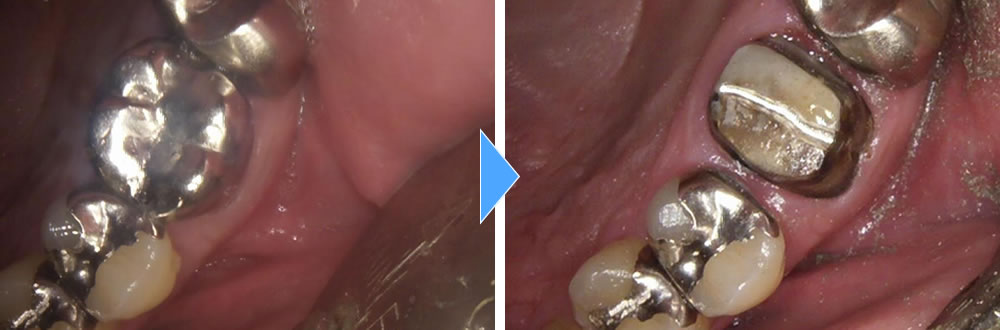 段差が気になる銀歯をセラミックで改善した症例