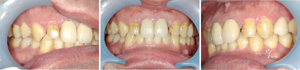 セラミック矯正で前歯の見た目を改善した症例