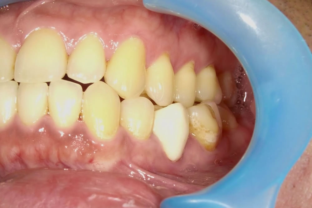 セラミック矯正で反対咬合を改善した症例