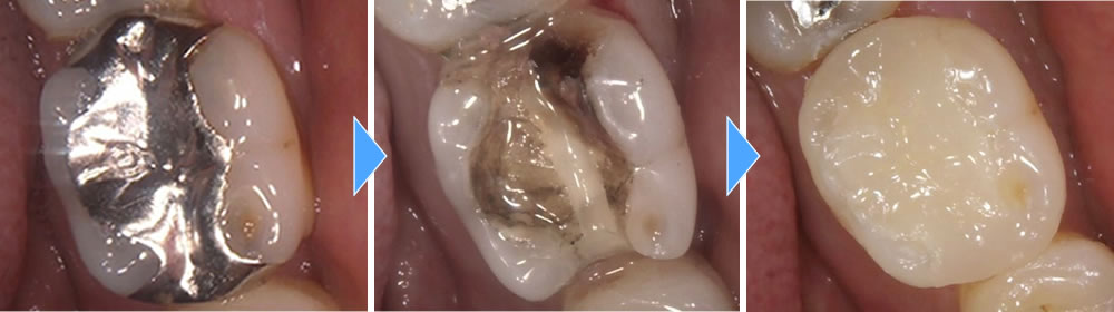 銀歯の虫歯治療後にセラミックインレーで修復した症例