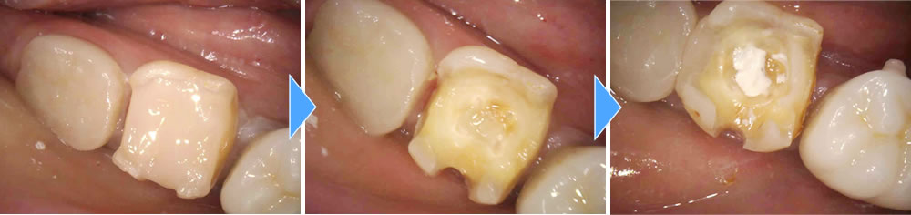  つめ物が取れた部分をジルコニアクラウンで修復した症例