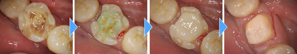  金属のつめ物が取れた部分をジルコニアクラウンで修復した症例