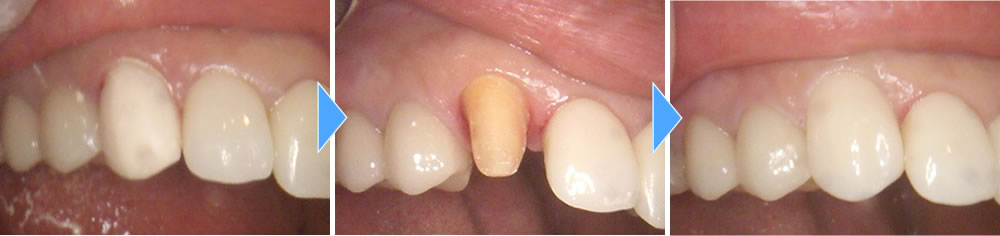  右上の犬歯をセラミッククラウンに変更した症例