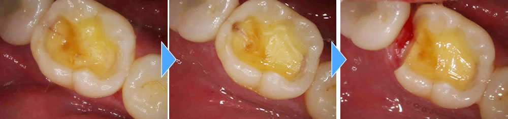  銀歯が取れた部分をセラミックインレーで修復した症例