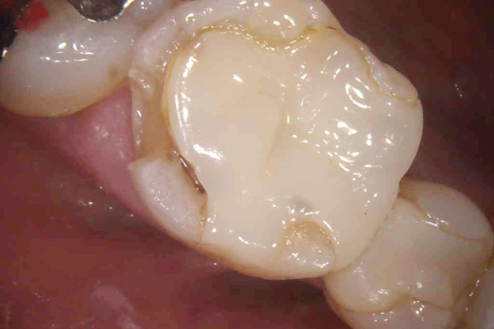  つめ物が欠けた部分をセラミックインレーで修復した症例
