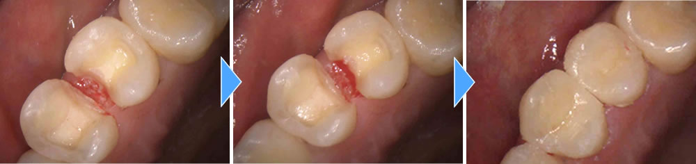  虫歯治療後にセラミックインレーで修復した症例