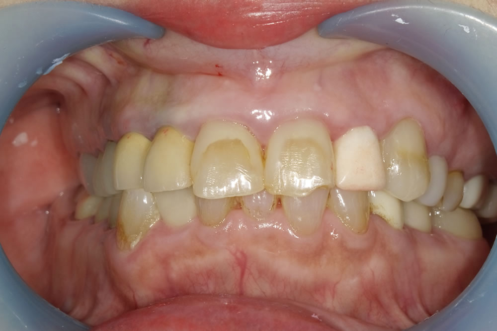  前歯の見た目をセラミック治療で改善した症例