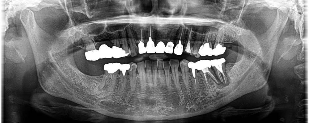痛みのある奥歯をインプラントで治療した症例