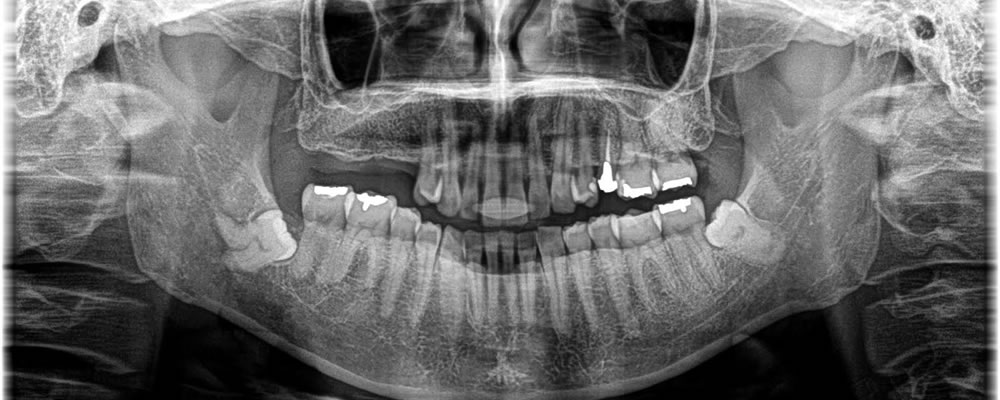  欠損部分に実施したインプラント治療の症例
