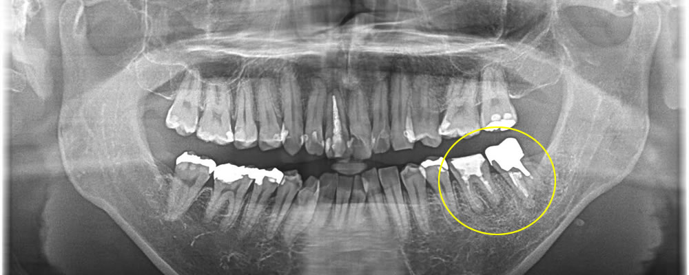  膿が溜まった歯を抜歯後にインプラントで治療した症例