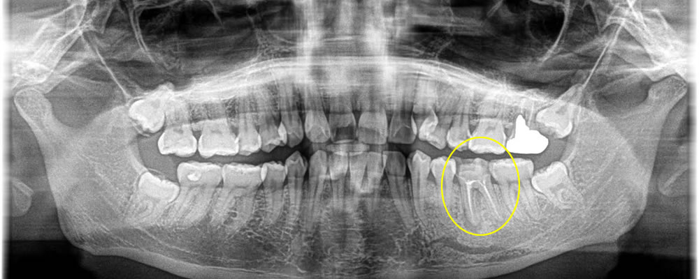 痛みのある歯を抜歯後にインプラントで治療した症例