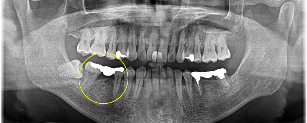 ブリッジ部分をインプラントで治療した症例
