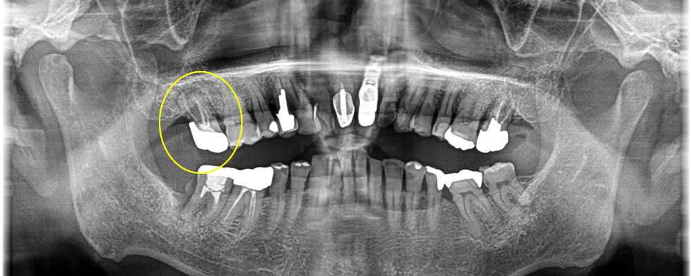 保存不可能な歯を抜歯後にインプラントで治療した症例