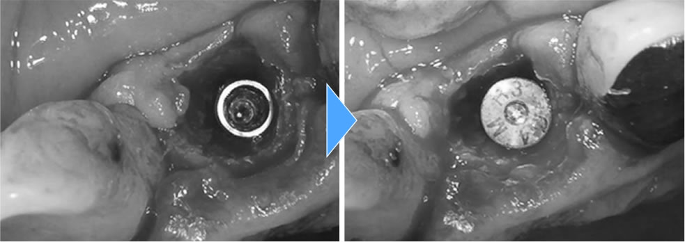  割れた前歯を抜歯即時インプラントで治療した症例