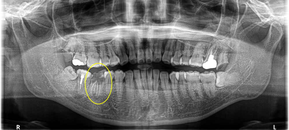 保存不可能な割れた奥歯を抜歯後にインプラントで治療した症例