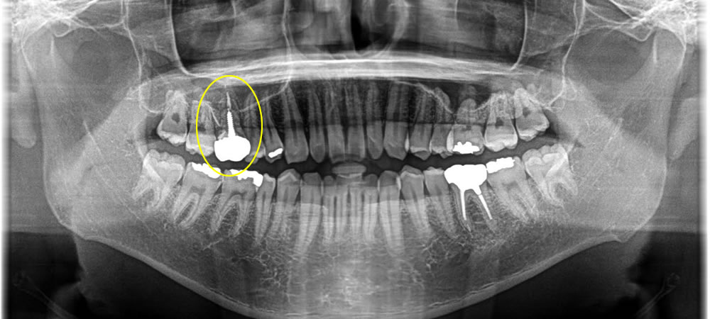  骨造成法を併用したインプラント治療の症例
