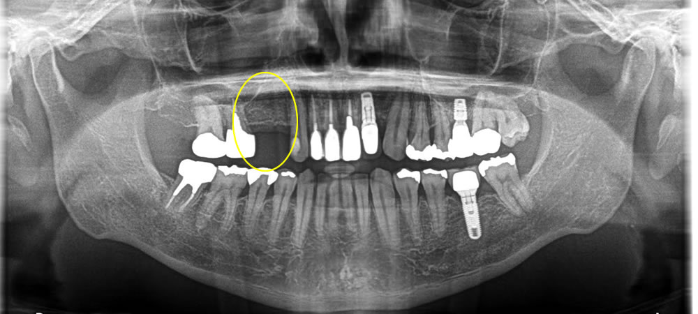 欠損部にインプラントを埋入して咬み合わせを回復した症例