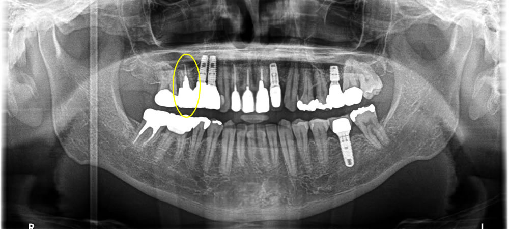 痛む歯を抜歯してインプラントで治療した症例