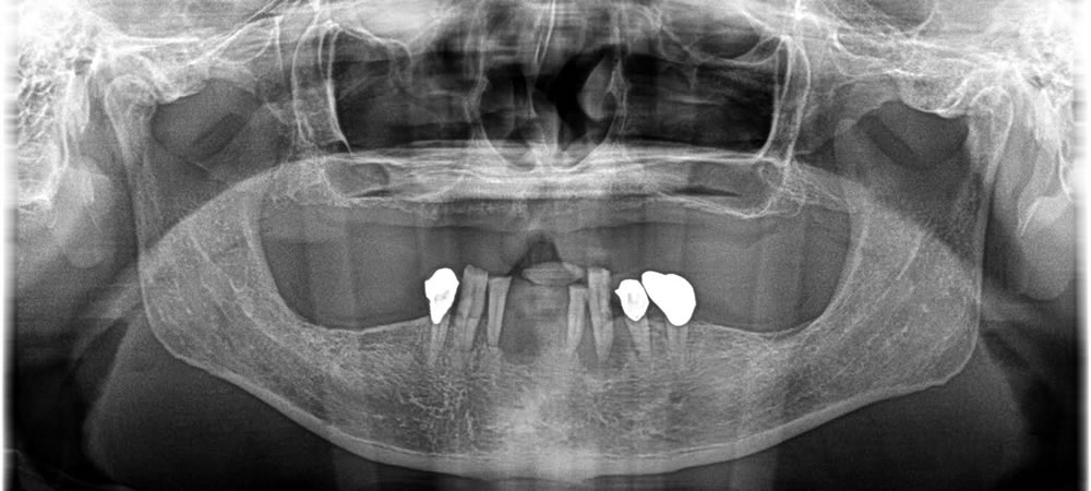 入れ歯とオールオン8による全顎治療の症例