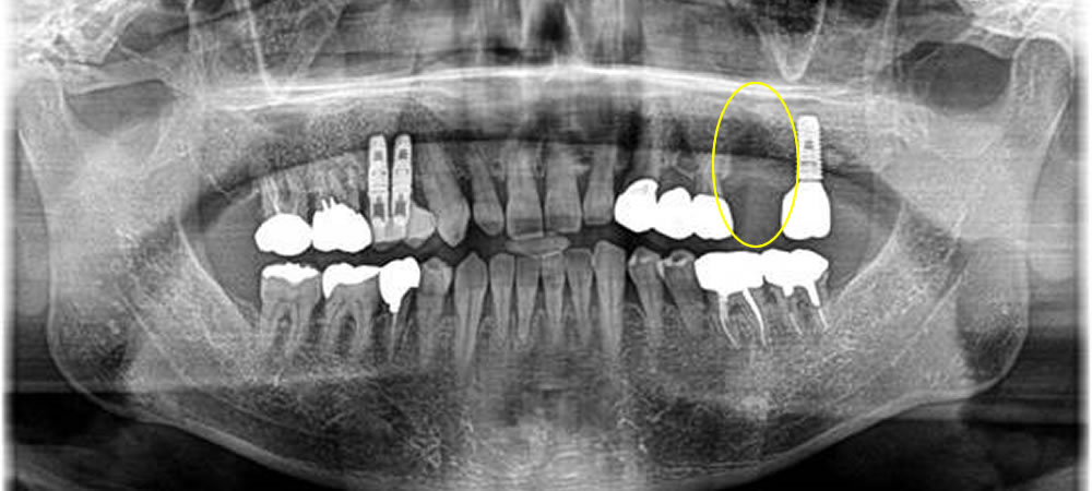 歯周病で歯を失った部分をインプラントで治療した症例