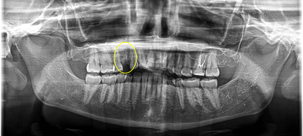保存不可能な歯を抜歯後にインプラント治療を実施した症例