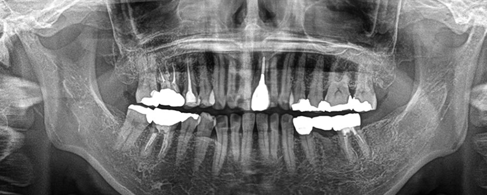 他院で抜歯した部分をインプラントで治療した症例
