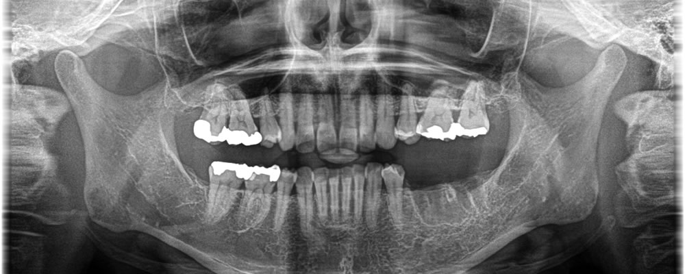  他院で抜歯した部分に実施したインプラント治療の症例