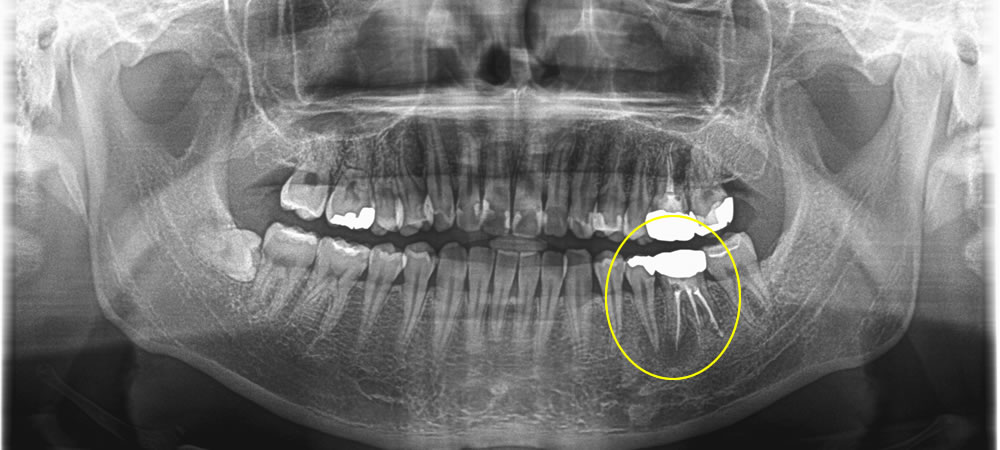  歯根に膿が溜まった歯を抜歯してインプラントで治療した症例