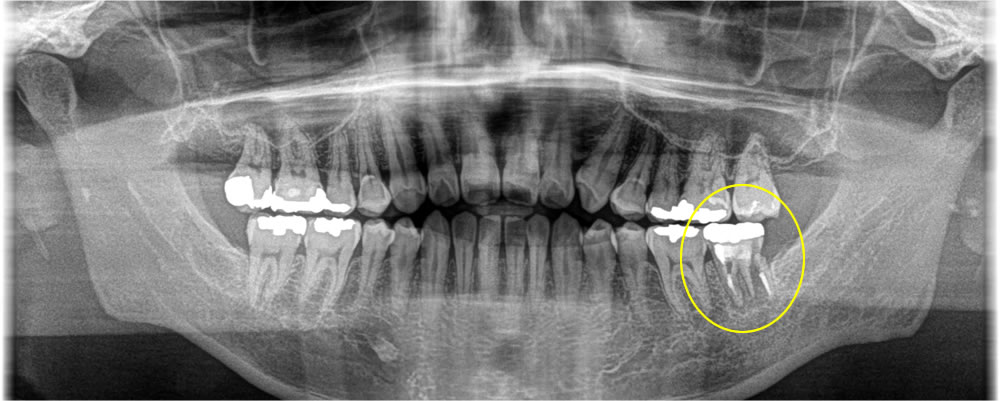 破折歯を抜歯後にインプラントで咬み合わせを改善した症例