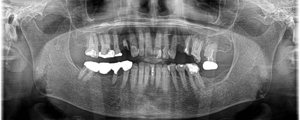 保存不可能な歯を抜歯後にインプラントで治療した症例