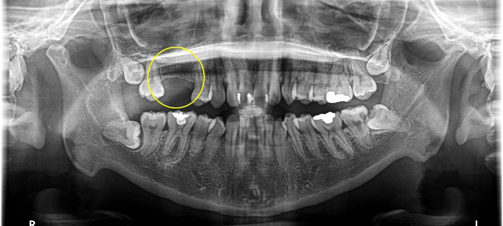 他院で抜歯した部分をインプラントで修復した症例