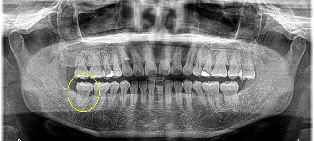 歯根破折した歯を抜歯してインプラントで治療した症例