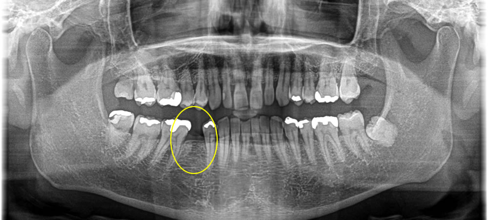  インプラント治療で抜歯した部分の咬み合わせを回復した症例