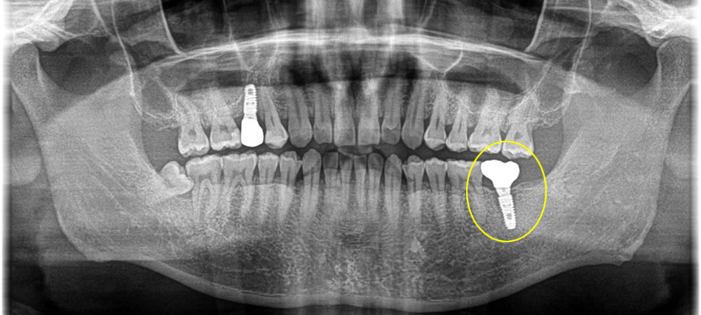 破折したインプラントを取り除いて再治療した症例