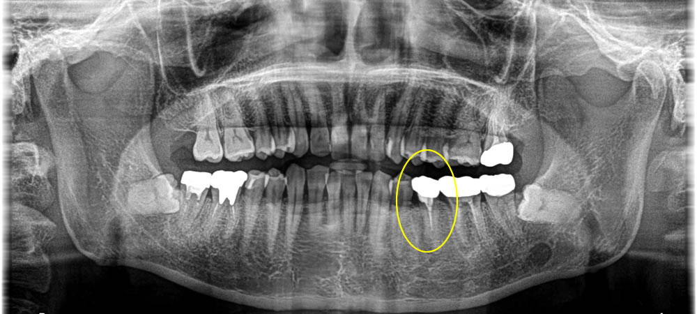 歯根破折した歯を抜歯してインプラント治療を行った症例
