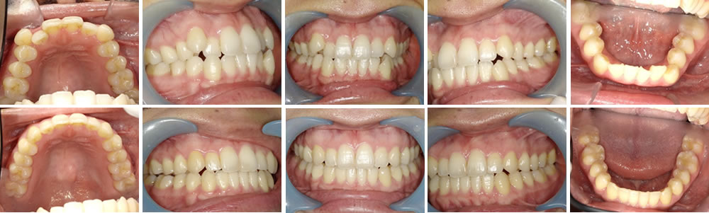 マウスピース矯正（インビザライン）で叢生を改善した症例
