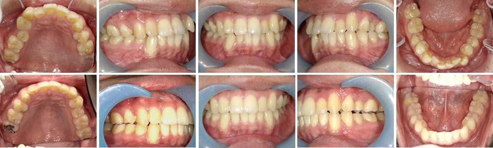 マウスピース矯正（インビザライン）で前歯の叢生を改善した症例