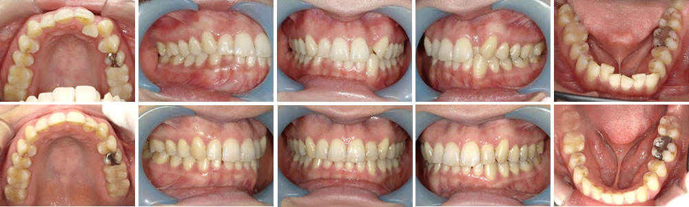  マウスピース矯正（インビザライン）で反対咬合を改善した症例