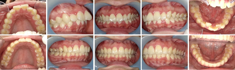 マウスピース矯正（インビザライン）で出っ歯・叢生を改善した症例