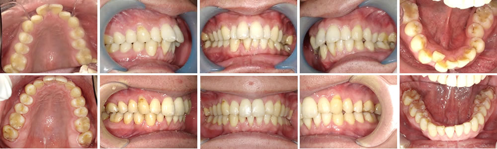 マウスピース矯正（インビザライン）で叢生を改善した症例