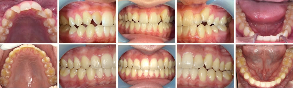 マウスピース矯正（インビザライン）で前歯の歯並びを改善した症例